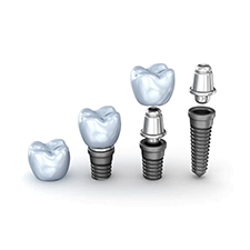 Nano Dental Implants